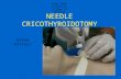 Needle Cricothyroidotomy 2 - Hatem Alsrour