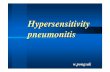 Hypersensitivity  Pneumonitis