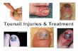 Nail injuries