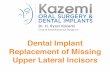 Dental Implants for replacement of Upper Lateral Incisors