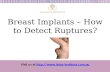 Silicone Breast Implants - How To Detect Ruptures