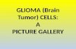Glial (brain tumor) cells a picture gallery