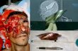 Point of Wounding: Head Injuries and TBI