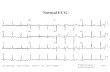 Normal ECG. A 55 year old man with 4 hours of "crushing" chest pain.