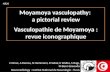 Moyamoya vasculopathy: a pictorial review Vasculopathie de Moyamoya : revue iconographique C Drissi, A Ramzu, N Hammami, R Sebaï, K Walha, S Nagi, M Ben.