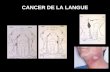 CANCER DE LA LANGUE T.N.M. CANCER DE LA LANGUE (6) EVOLUTION NATURELLE : en arrière : base de langue puis pharyngolarynx en bas : plancher buccal (génioglosse,