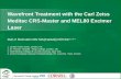 Wavefront Treatment with the Carl Zeiss Meditec CRS-Master & MEL80 Excimer Laser