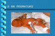 O RN PREMATURO. O RN PREMATURO DEFINIÇÃO: Rn prematuro é todo aquele que nasce antes de 37 semanas completas de gestação ( trinta e sete semanas e seis.