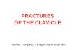 Fractures of the clavicle
