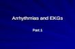Arrythmias and ek gs 1