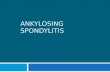Ankylosing spondylitis clinical feature and diagnosis