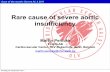 Rare cause of severe aortic insufficiency