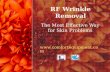 RF Wrinkle Removal-The Most Effective Way for Skin Problems