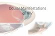 Ocular manifestations of hiv