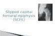 Slipped capital femoral epiphysis vamshi kiran feb 6/2013