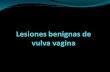 Lesiones benignas de vulva y vagina