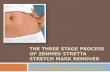 The three stage process of zenmed stretta stretch