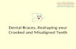 Dental Braces, Reshaping your Crooked and Misaligned Teeth