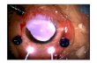 Forlini artificial iris for large post traumatic iris coloboma pediatric