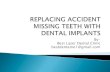 Replacing accident missing teeth with dental implants