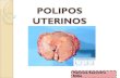 Polipos endometriales y endocervicales