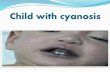 Child with cyanosis