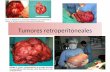 Tumores retroperitoneales