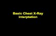 Basic chest x ray interpretation
