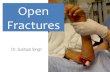 management of open fracture