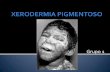 Xerodermia pigmentoso