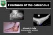 Calcaneal fractures