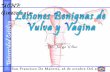 Lesiones benignas de vagina y vulva
