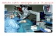 Brèche ostéo-méningée post-otoneurochirurgie