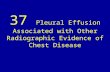 37 pleural effusion associated with other radiographic evidence