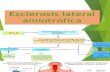Esclerosis Lateral Aminotrofica Exponer 1