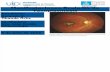 Manifestaciones Oculares de Toxoplasmosis