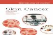 Skin Cancer the Biology of Cancer