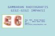 Gambaran Radiografis Gigi Impaksi