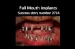 Full Mouth Implants