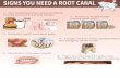 Signs You Need A Root Canal