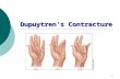 1 Dupuytren’s Contracture. 2  Fibrous tissue of the palmar fascia to shorten and thicken  Common in men older than 40 years; in persons of Northern.