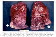 Lungs are distended and red. The reddish coloration of the tissue is due to congestion (alveolar capillaries are engorged with blood). Some normal pink.