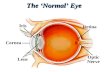 Lens Cornea Iris Optic Nerve Retina The ‘Normal’ Eye.