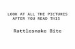 LOOK AT ALL THE PICTURES AFTER YOU READ THIS Rattlesnake Bite.