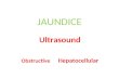 JAUNDICE Ultrasound Obstructive Hepatocellular. Obstructive Jaundice Gallstones Pancreatic Cancer Cholangiocarcinoma Ampullary tumour Benign Biliary stricture.
