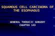 SQUAMOUS CELL CARCINOMA OF THE ESOPHAGUS GENERAL THORACIC SURGERY CHAPTER 143.
