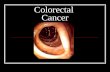 Colorectal Cancer. Summary: Content of Colorectal Cancer Tutorial Statistics Anatomy of the gastrointestinal tract Colorectal cancer Cancer progression.