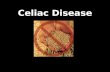 Celiac Disease. Recent Prevalence of Celiac Disease 1 in 133 people have CD Prevalent, but under diagnosed – Those not diagnosed have a higher death rate.