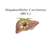 Hepatocellular Carcinoma (HCC). Different types of cancer can behave very differently. For example, lung cancer and breast cancer are very different diseases.