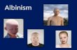 Albinism is also known as Oculocutaneous albinism, Ocular albinism and, Hermansky-Pudlak syndrome.